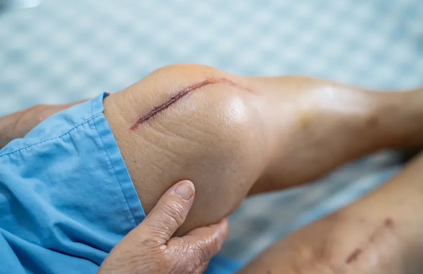 What is the Recovery Time for Robotic Knee Replacement?